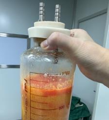 沈阳水动力吸脂手术要做多久？